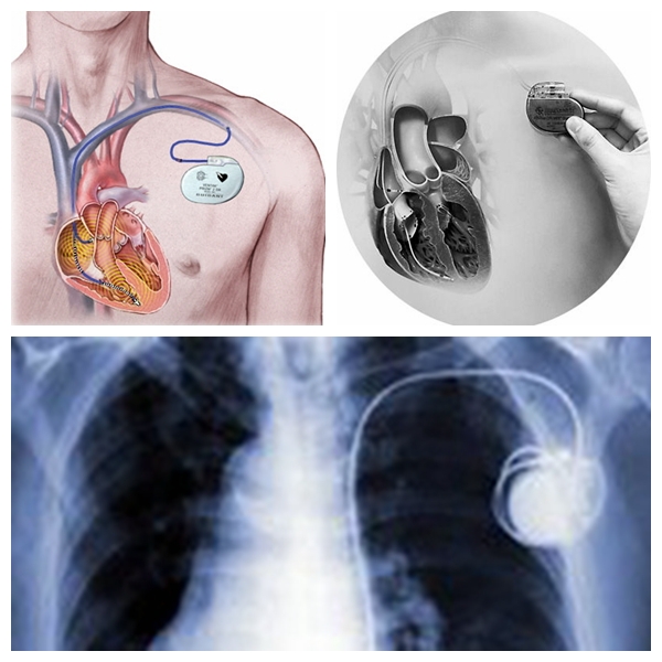 成都长江医院心血管内科成功开展心脏起搏器植入术
